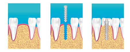 étape de l'implant dentaire Maisons Alfort